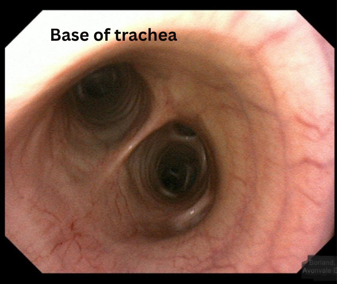 Base of Trachea